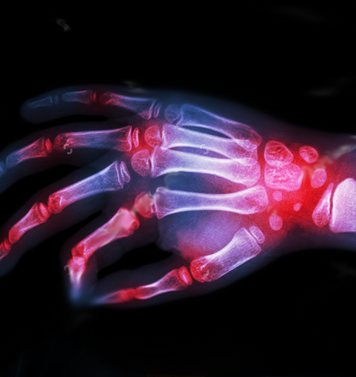 Rheumatoid Arthritis