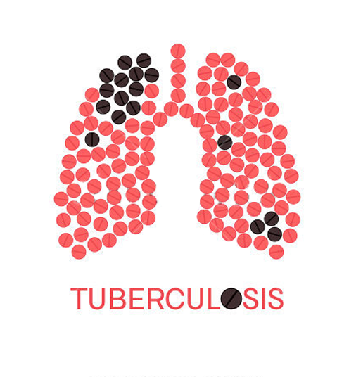 Tuberculosis